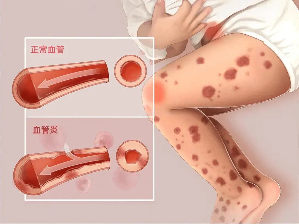 单纯性紫癜最明显的症状是什么？
